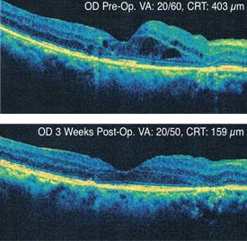 Micropulse before and afters