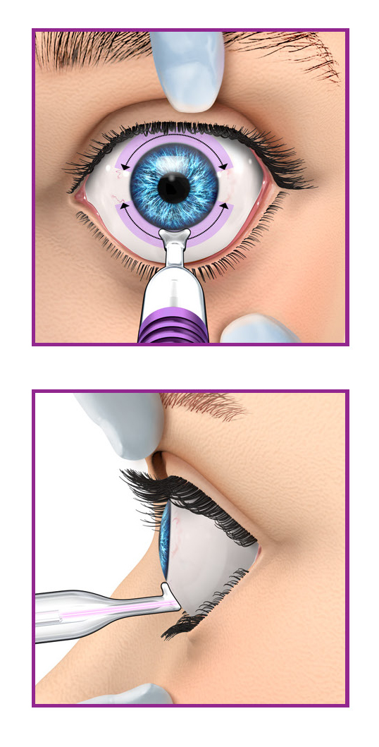 MicroPulse P3 Device for NonIncisional Therapy