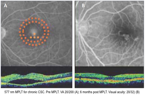 Central Serous Chorioretinopathy