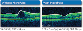 Diabetic Macular Edema