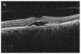 Age-Related Macular Degeneration