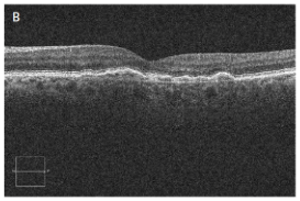 Age-Related Macular Degeneration